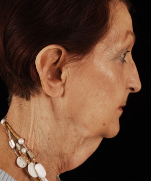 before face and neck lift side view female patient case 5661