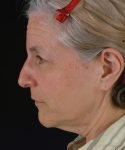 before facelift / neck lift side view female patient 5666