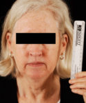 before facelift / neck lift front view female patient 5671
