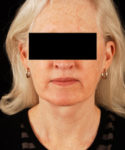 after facelift / neck lift front view female patient 5671