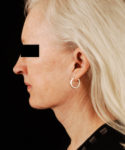 after facelift / neck lift side view female patient 5671