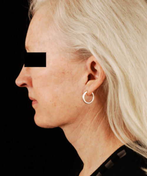 after facelift / neck lift side view female patient 5671