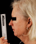 before facelift / neck lift side view female patient 5671