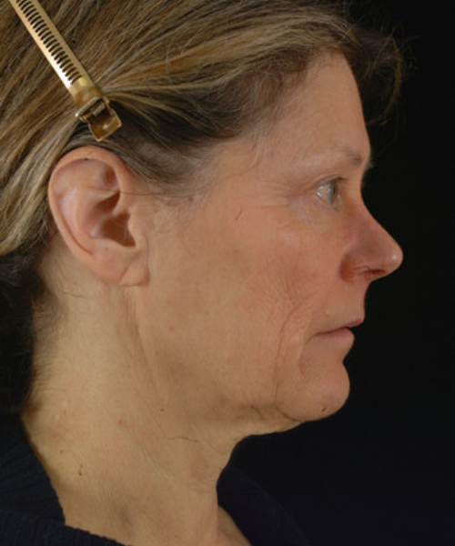 before facelift / neck lift side view female patient 5676