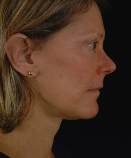 after facelift / neck lift side view female patient 5676