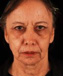 before facelift / neck lift front view female patient 5681