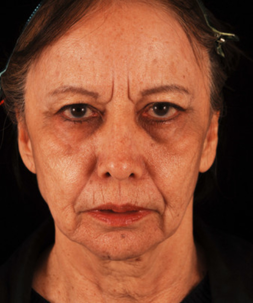 before facelift / neck lift front view female patient 5681