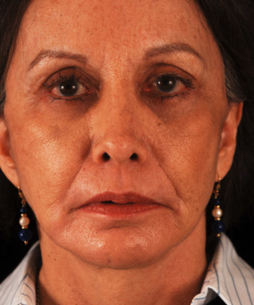 after facelift / neck lift front view female patient 5681