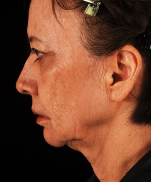 before facelift / neck lift side view female patient 5681