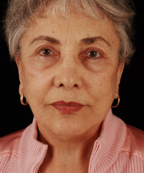 after facelift / neck lift front view female patient 5691