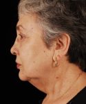 before facelift / neck lift side view female patient 5691