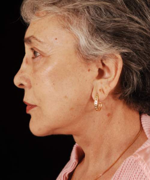 after facelift / neck lift side view female patient 5691