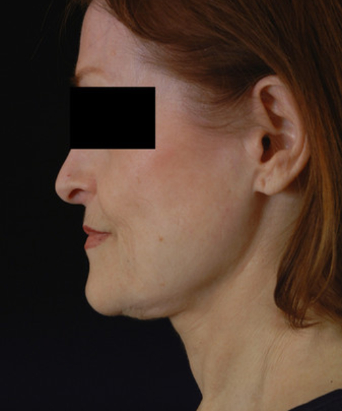 before facelift / neck lift side view female patient 5701