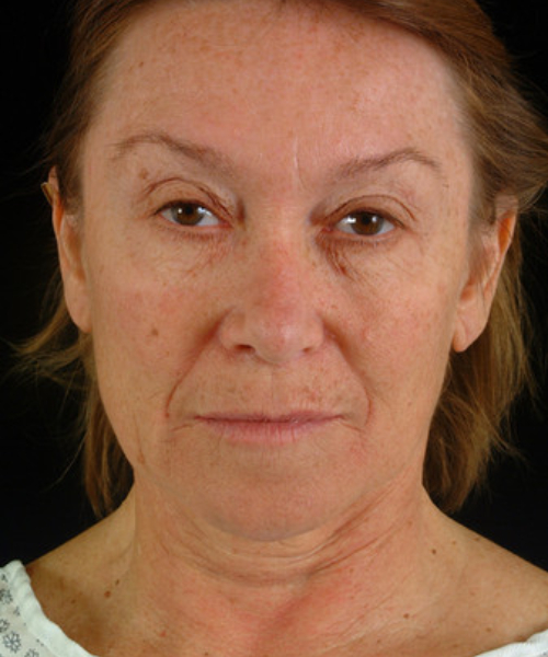 before facelift / neck lift front view female patient 5707