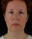 before neck lift front view female patient case 5724