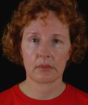 after neck lift front view female patient case 5724