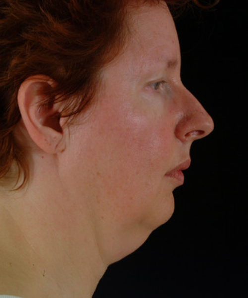 before neck lift side view female patient case 5724