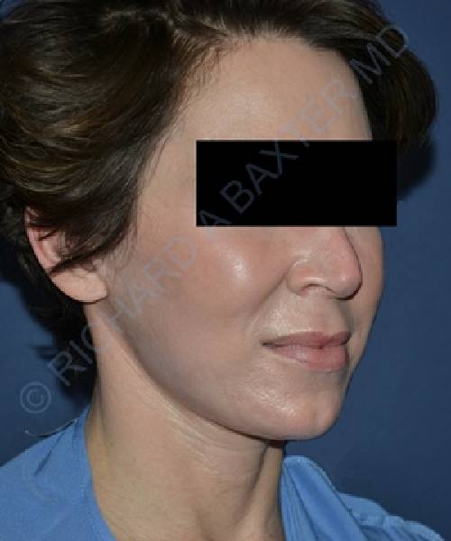 after facelift | neck lift female patient right angle view case 4791