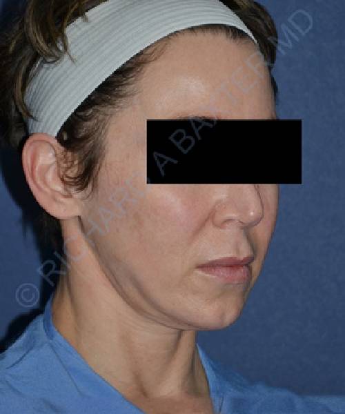 before facelift | neck lift female patient right angle view case 4791