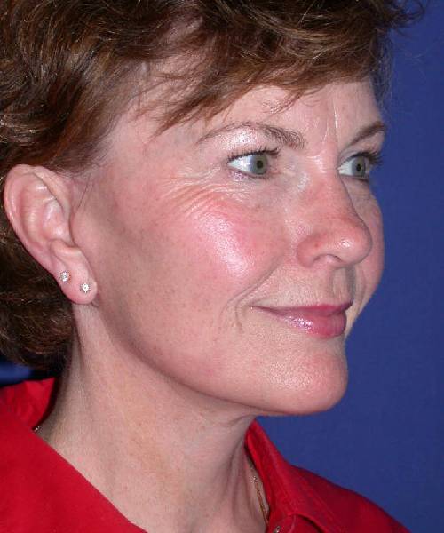 after facelift | neck lift female patient right angle view case 4801