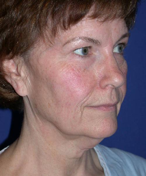 before facelift | neck lift female patient right angle view case 4801
