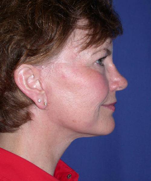 after facelift | neck lift female patient right side view case 4801