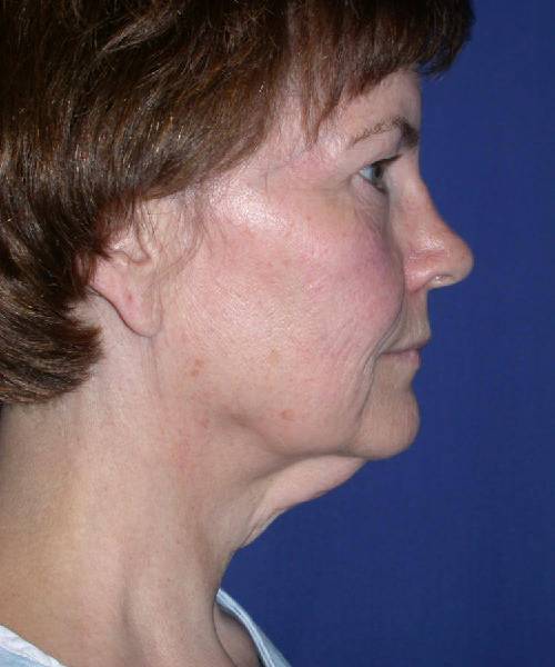 before facelift | neck lift female patient right side view case 4801