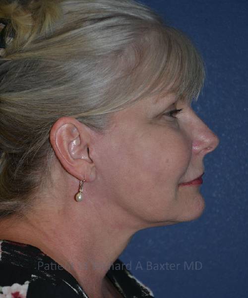 after facelift | neck lift female patient right side view case 4813