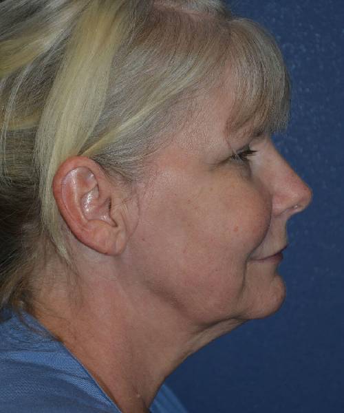 before facelift | neck lift right side view case 4813