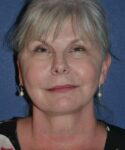 after facelift | neck lift female patient front view case 4813