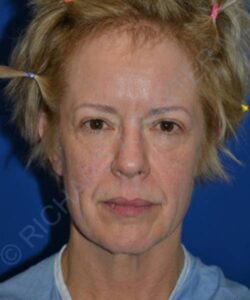 before facelift | neck lift female patient front view case 4818