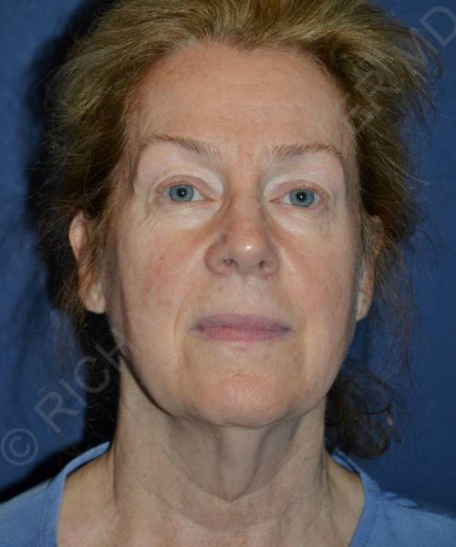 before facelift | neck lift female patient front view case 4826