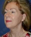 after facelift | neck lift female patient left angle view case 4826