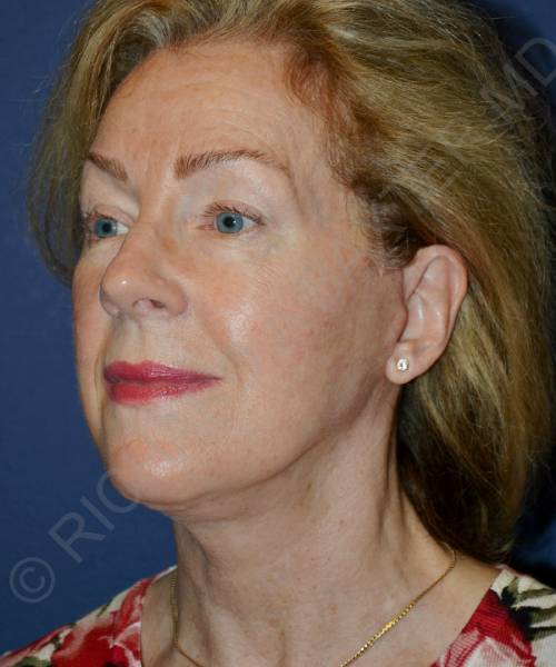 after facelift | neck lift female patient left angle view case 4826