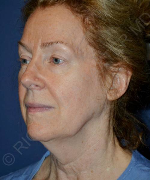 before facelift | neck lift female patient left angle view case 4826