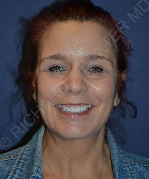 after facelift | neck lift female patient front view case 4831