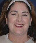 after facelift | neck lift female patient front view case 4849