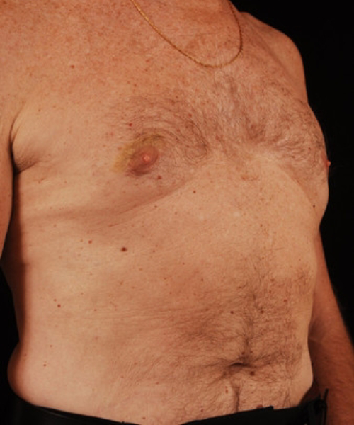 after gynecomastia right angle view case 5291