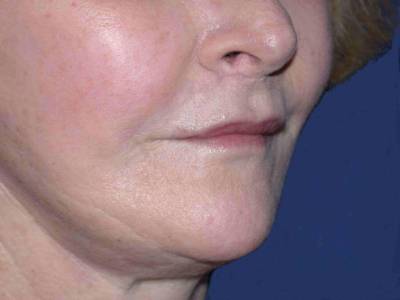 after injectables right angle mouth view female patient case 5744