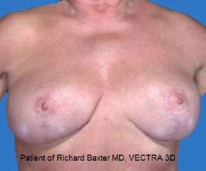 after internal bra front view case 4898