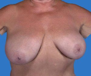 before internal bra front view case 4898