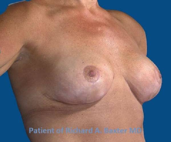 after internal bra right angle view case 4901
