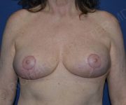 after internal bra front view case 4906