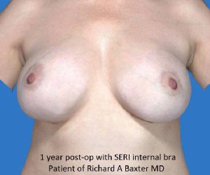 after internal bra front view case 4919