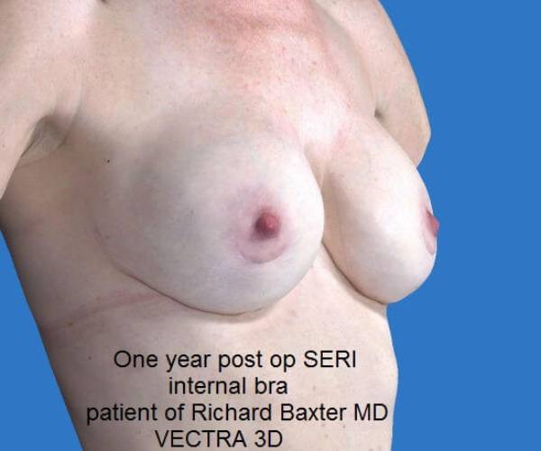 after internal bra right angle view case 4922