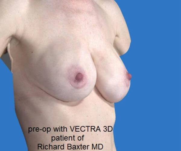 before internal bra right angle view case 4922