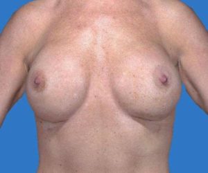 after internal bra front view case 4930