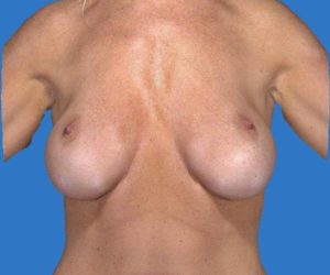 before internal bra front view case 4930