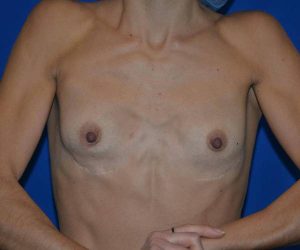 before internal bra front view case 4933