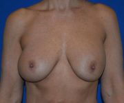 before internal bra front view case 4938
